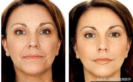 面部提升最新方法與小巷深處的秘密小店揭秘