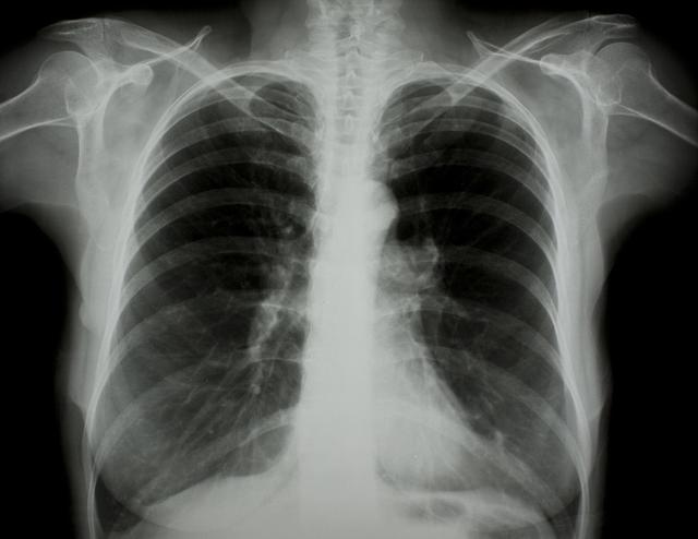 涪陵最新肺炎疫情動態(tài)更新??