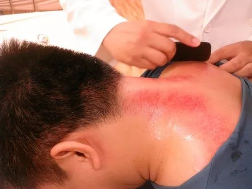 最新擰痧步驟指南與操作詳解